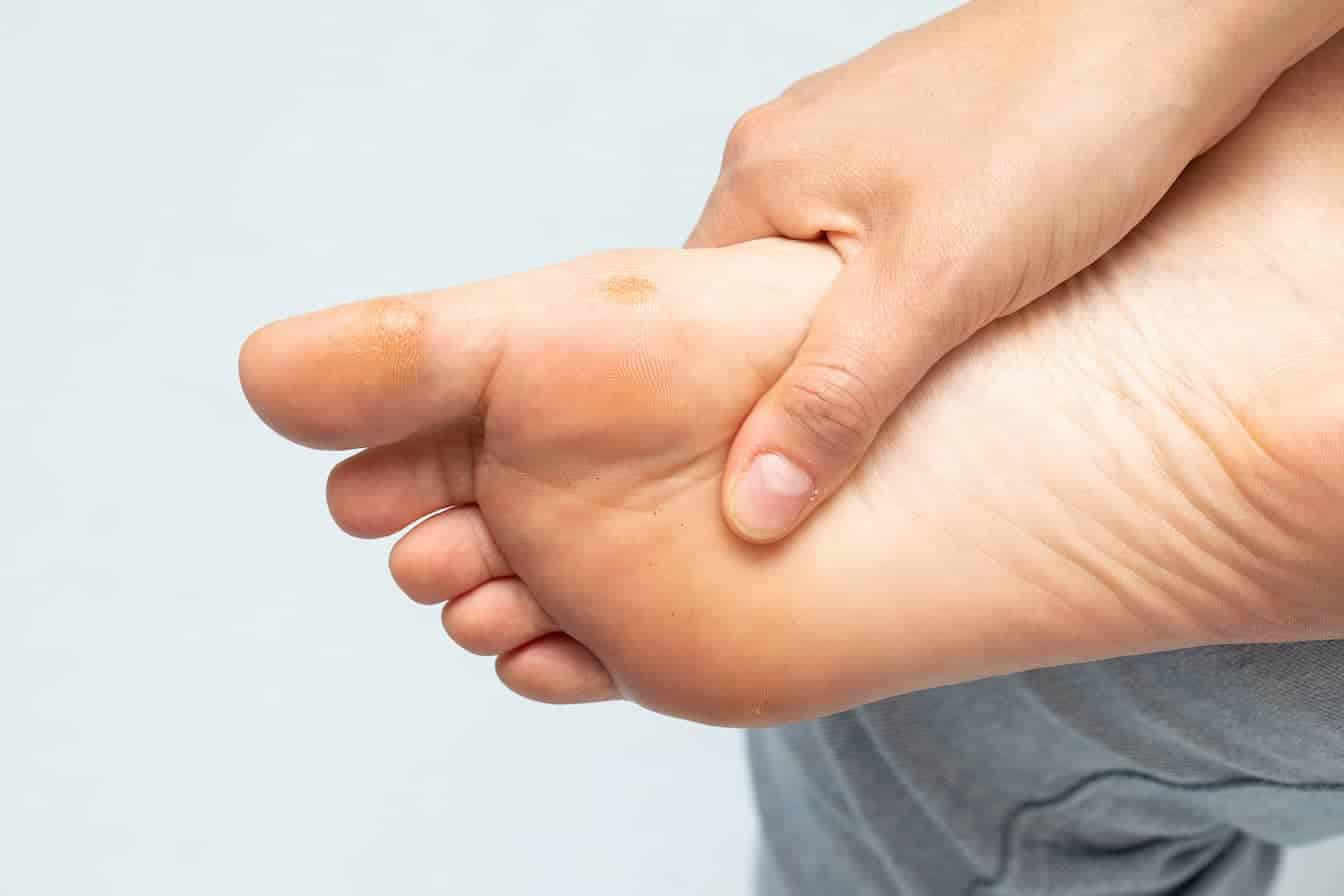 Calluses on diabetic foot