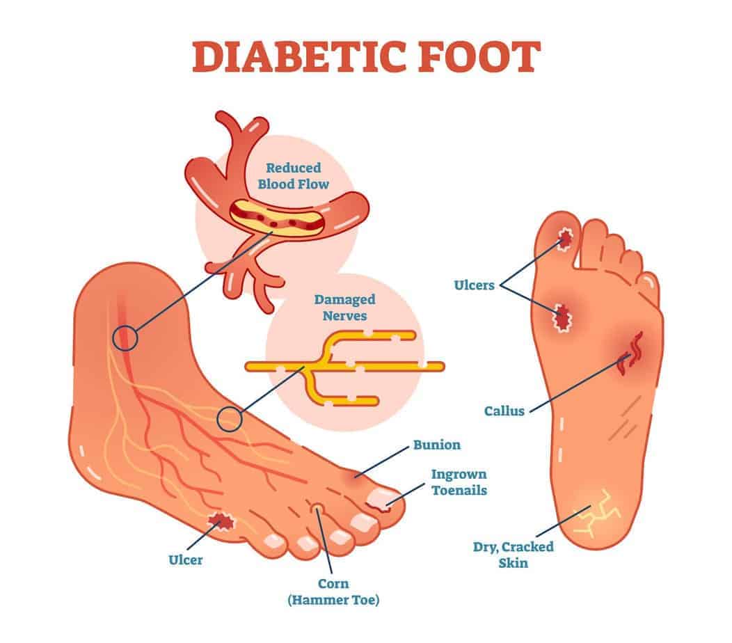 Diabetic Foot Problems with pictures