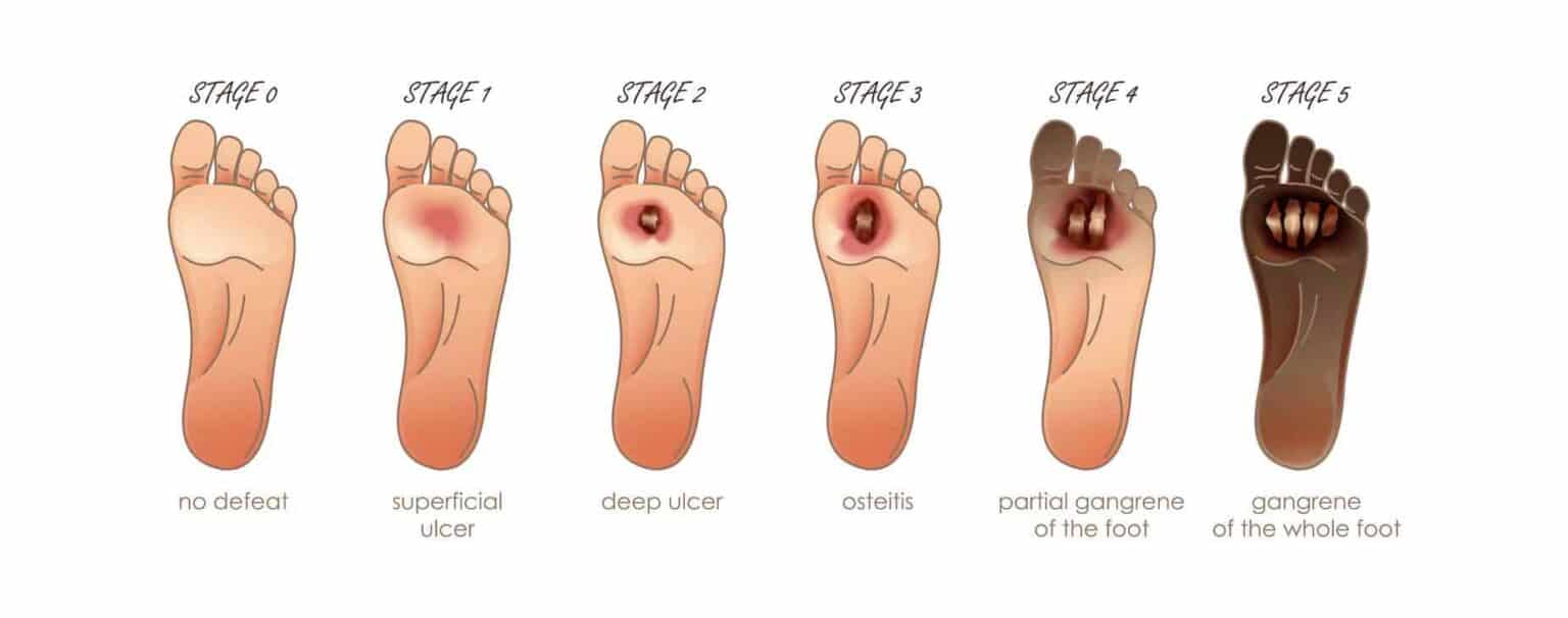 Wagner scale of diabetic foot ulcers