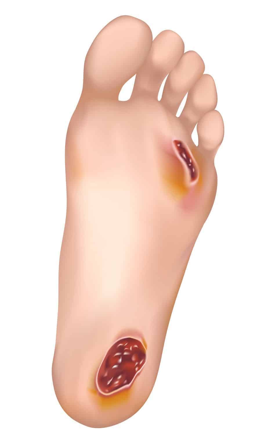 Diabetic foot ulcer picture