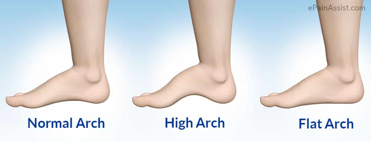 What foot arch type are you?