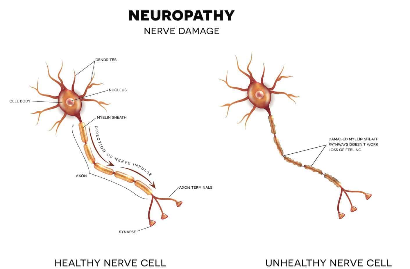 Damaged nerves from diabetic neuropathy